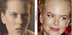 before-after-nicole-kidman-by- ... before-after-nicole-kidman-by- ...
