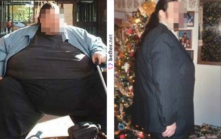 After Gastric Bypass