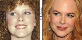 before-after-nicole-kidman-2- ... before-after-nicole-kidman-2- ...